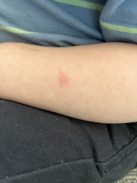 Does this look like chicken pox?