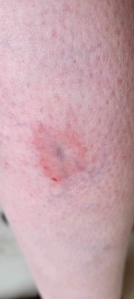 Is this Bulls Eye ( Lyme disease)? Pictures added, any Dr here please?