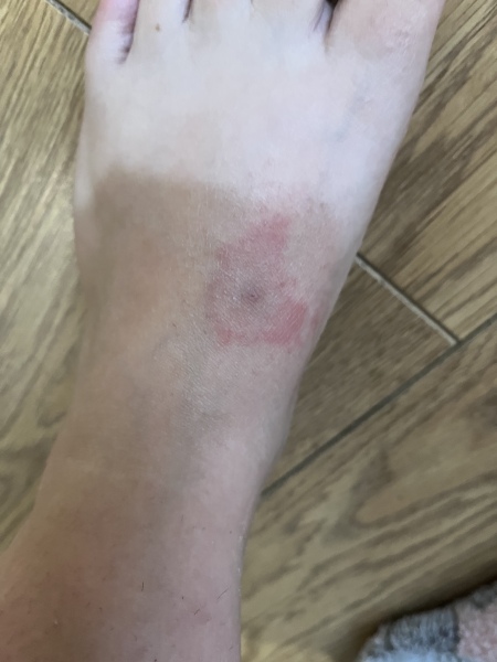 Insect bite, infected?
