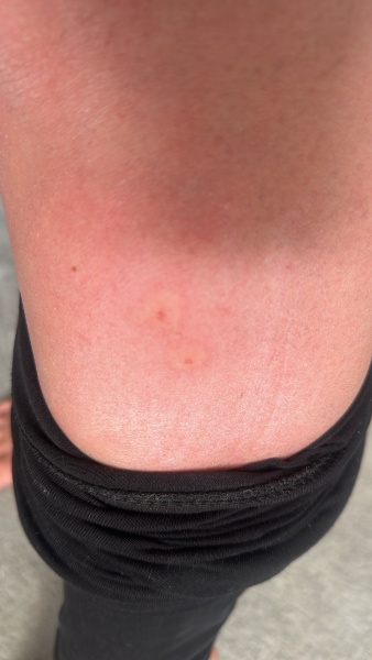 Bites