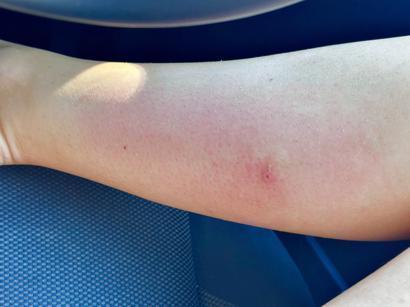 Is this wasp sting looking okay?