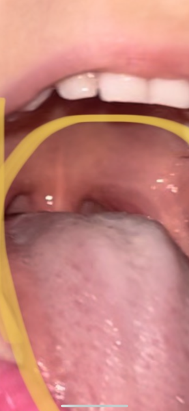 Strep A / tongue/ infection or vial?