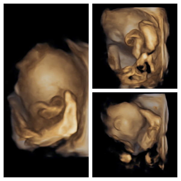 ERA/Alice/Emma infertility thread graduates/pregnancies