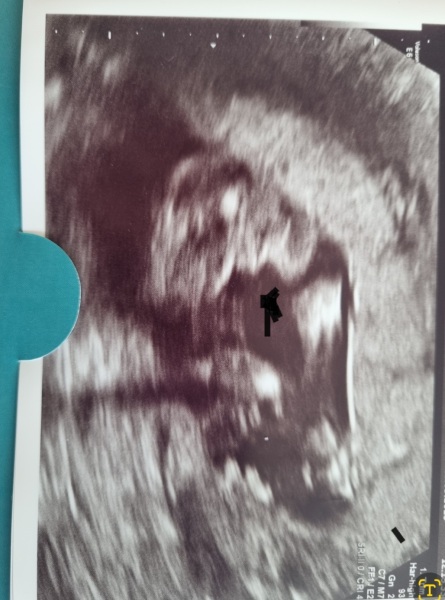 Gender help -19 week 2 days