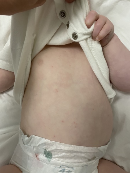 To think this is not chicken pox?