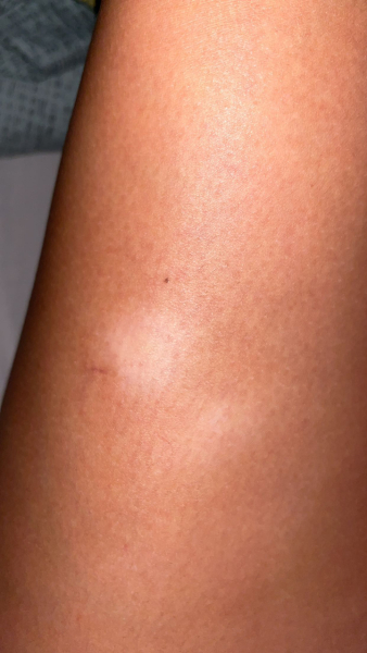 Anyone please help itchy patches on leg