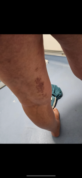 Is this a blood clot?