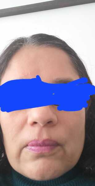 What's your opinion on botox?