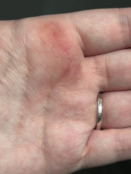 Weird bruise on hand ?!