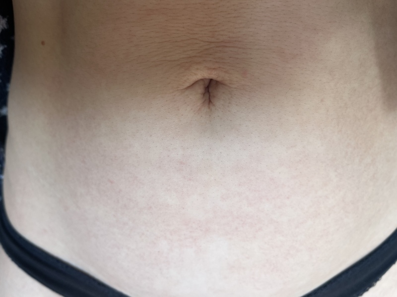 Weird patches on skin? Rash? Petechiae?