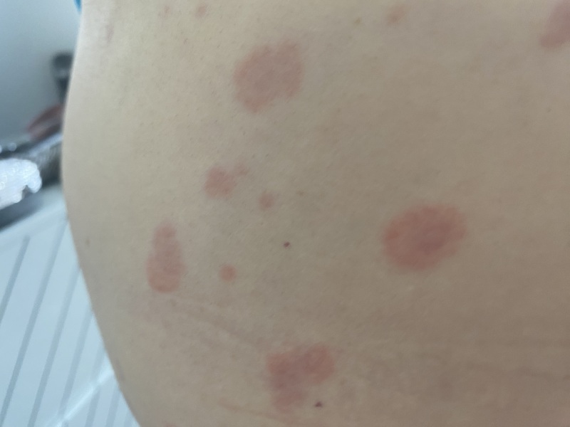 Can anyone help - is this pityriasis rosea??