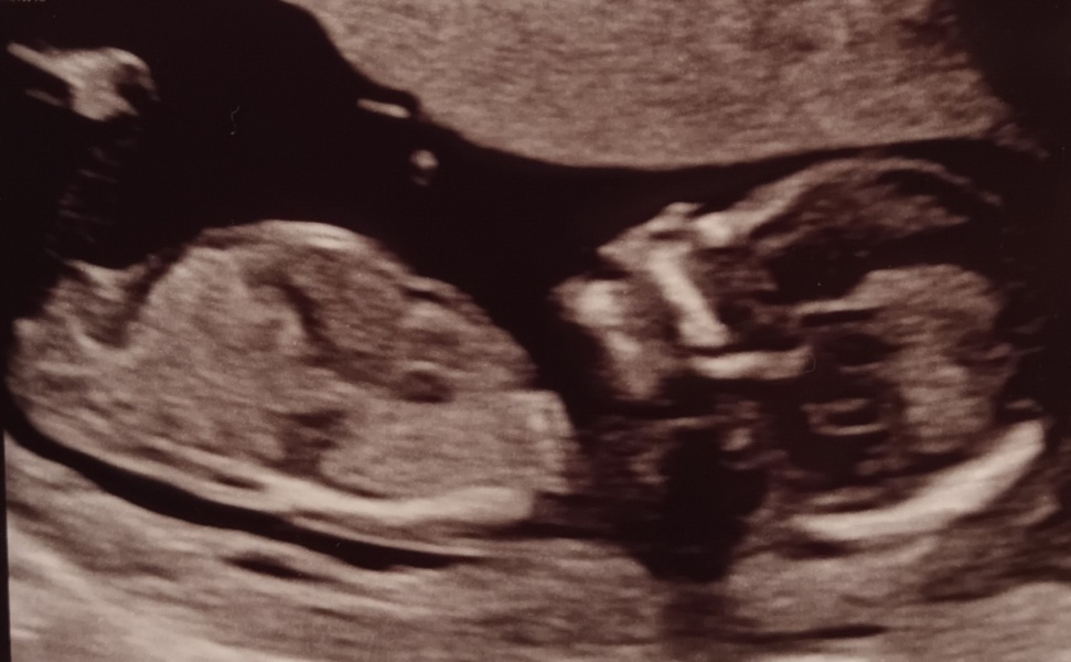 Nub … I think it’s a 3rd boy!