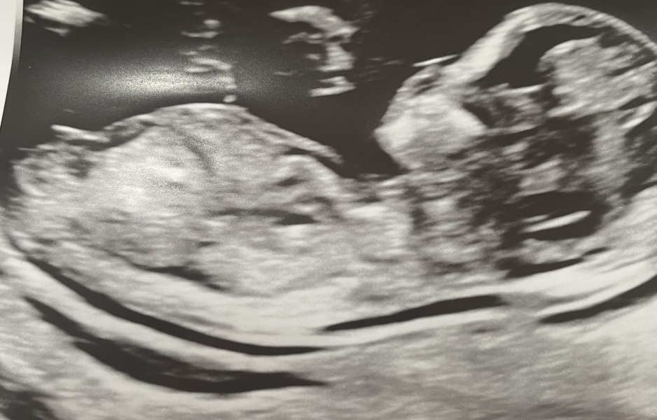 Nub … I think it’s a 3rd boy!