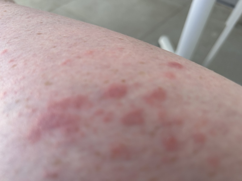 Rash