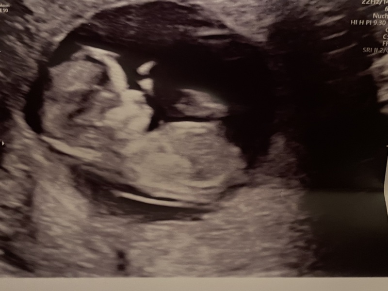 Boy or girl - anyone feel like guessing? 12wk scan