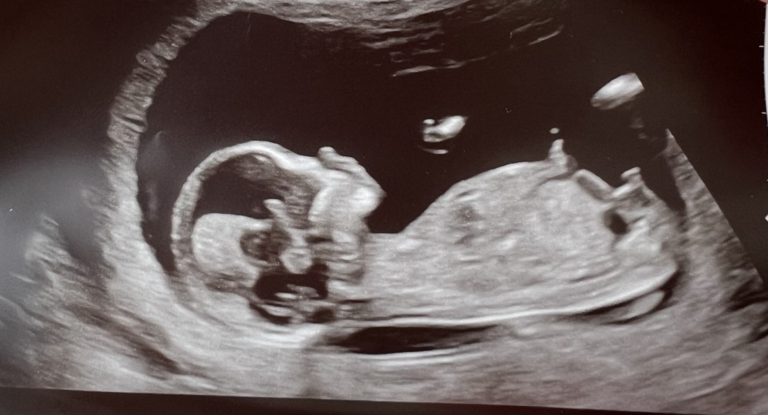 Did anyone have a boy nub on their 12 week scan but end up having a girl?