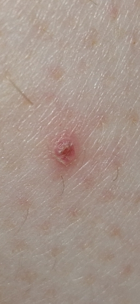 To go to GP for tiny mole?