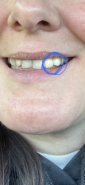 Permanent crown looks worse that temporary