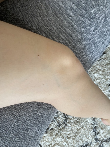 Do the veins in my legs look normal?
