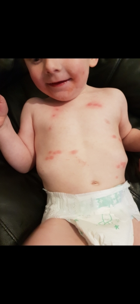 Bites