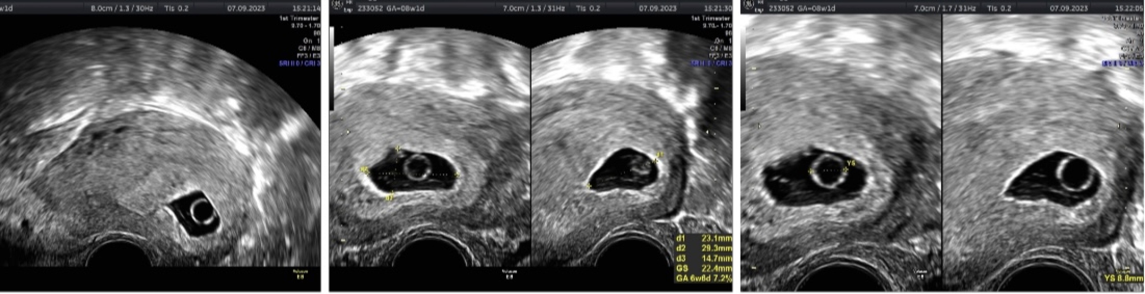 Ultrasound 7 weeks 4 days no embryo