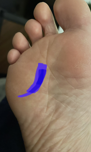 If not plantar fasciitis then what? Painful! Pic sorry