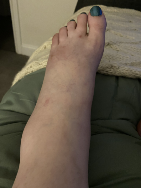 I've been diagnosed with advanced Lyme disease