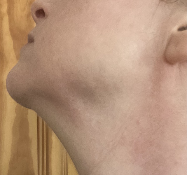 To ask if this is a swollen lymph node?