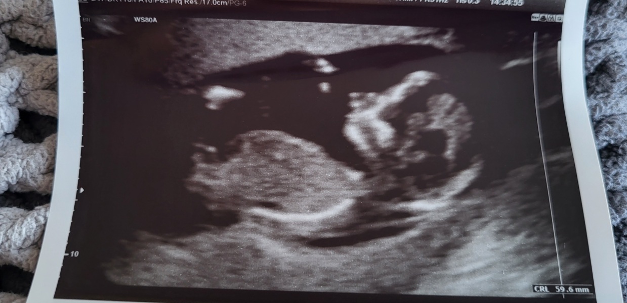 1/6 chance of Down syndrome baby