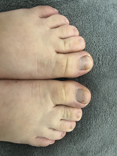 What are these weird freckles on my toe nail?