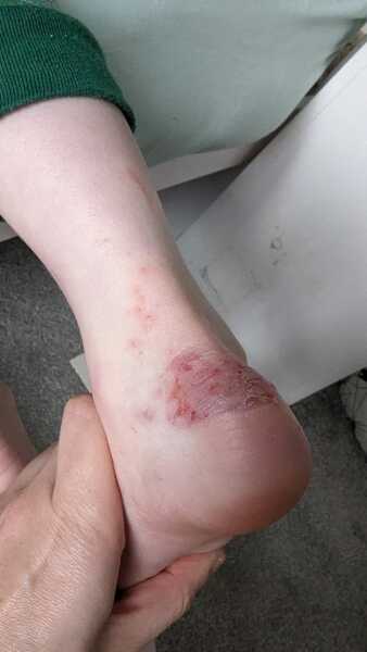 Eczema or something else?