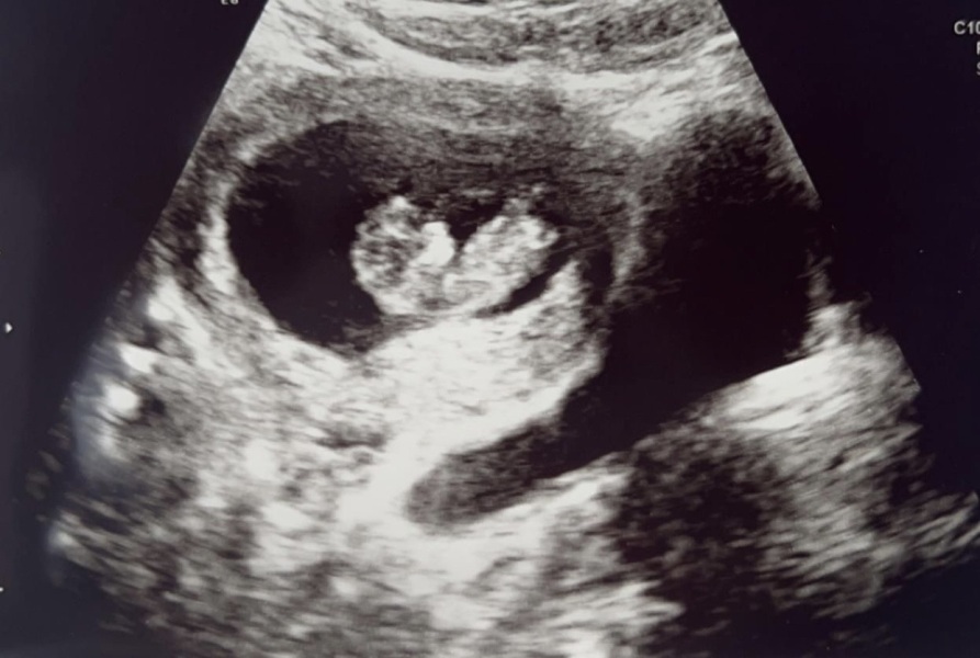 10 week scan, 2 sacks?