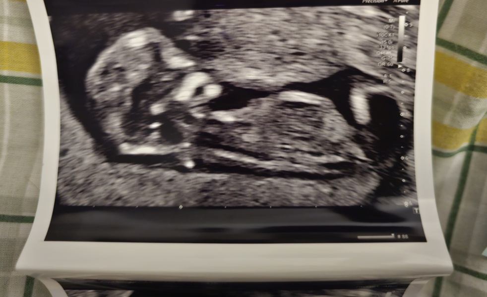 13 weeks 1 day scan