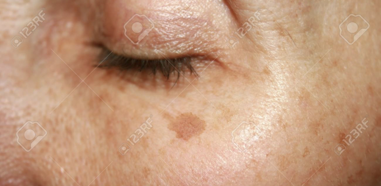Facial age spot