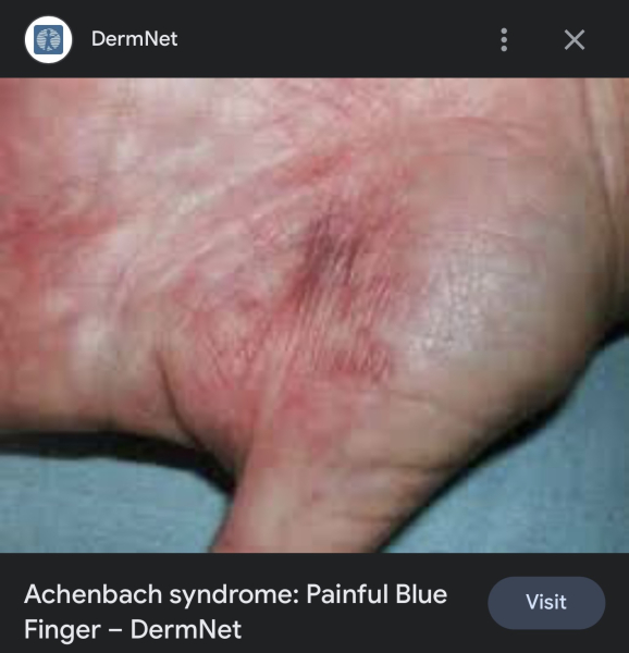 Weird bruise on hand ?!