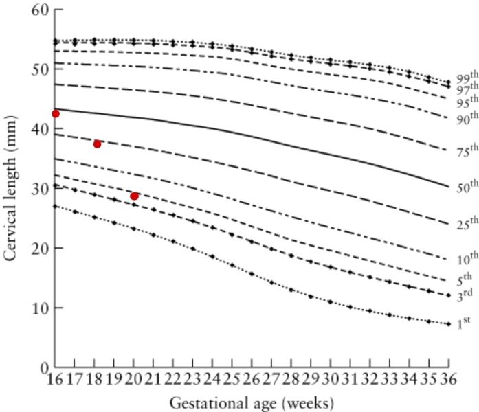 Rate of cervical change a worry