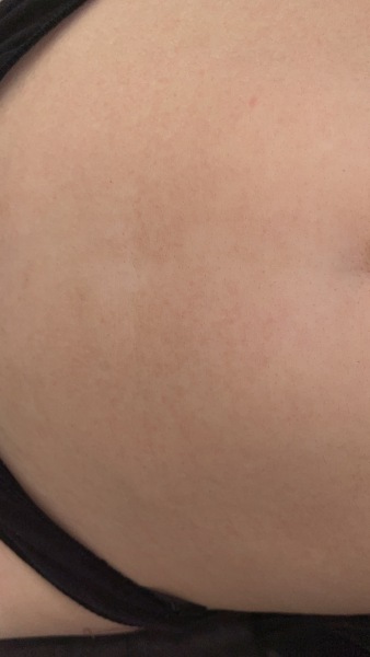 Petechiae rash?