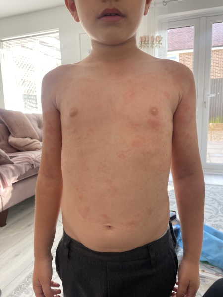 To think my child should be allergy tested ?  Pics
