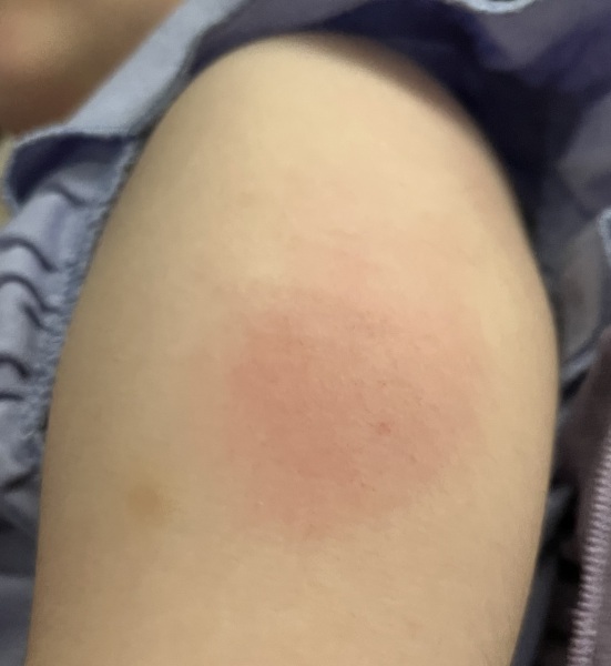 Localised vaccination reaction (photo included)