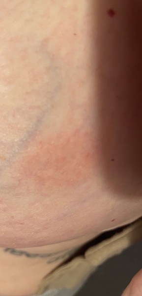 Inflammatory breast cancer?