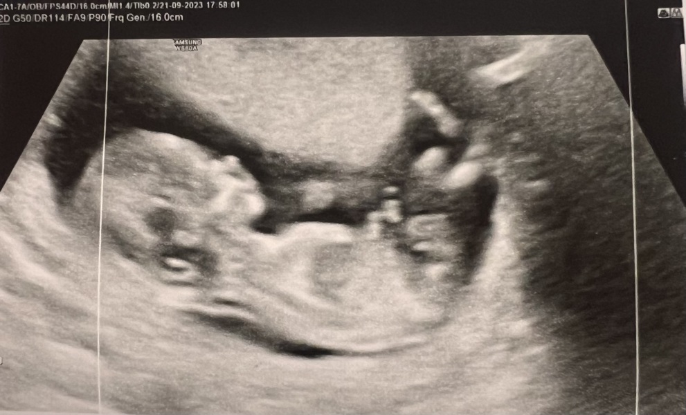 Boy or Girl - skull head / nub theory