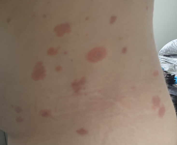 Can anyone help - is this pityriasis rosea??