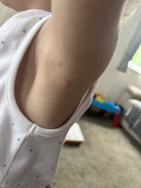 Is this chicken pox?