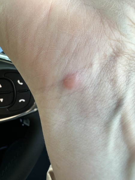 Lump in hand - any ideas?
