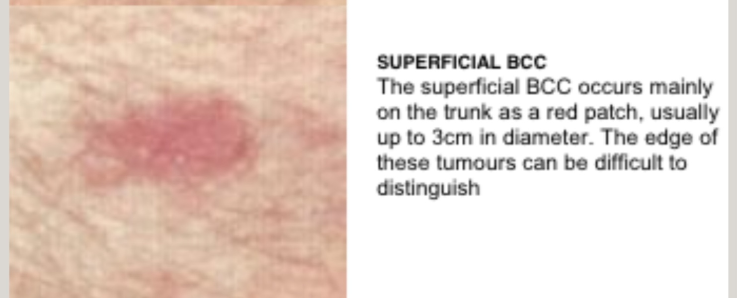 Basal cell carcinoma?