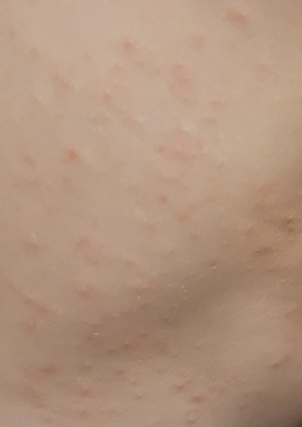 Any weird rashes going round?