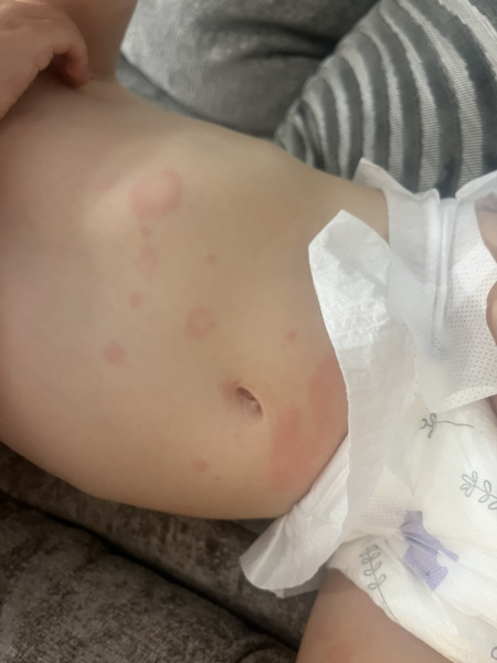 Can anyone help - is this pityriasis rosea??