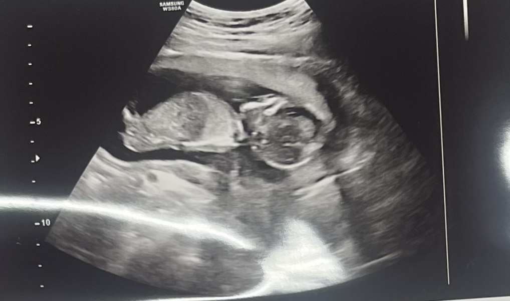 Girl or boy??? 12 week scan