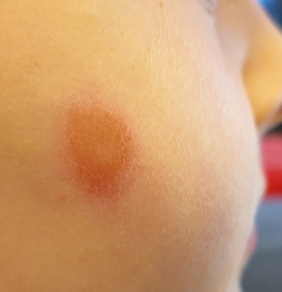 Fungal or impetigo