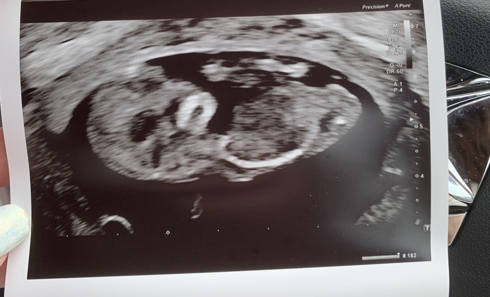 Nub theory, please? Second baby!